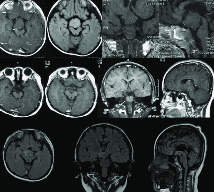MRI hersenscans van verschillende patienten